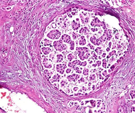 Nadofaragene firadenovec vncg - A. Disease progression while taking Adstiladrin (nadofaragene firadenovec-vncg) or prior treatment with adenovirus-based drugs. B. Members with extra-vesical (i.e., urethra, ureter, or renal pelvis), muscle invasive (T2-T4), or metastatic urothelial carcinoma. C. Dosing exceeds single dose limit of Adstiladrin (nadofaragene firadenovec-vncg) 75 ...